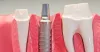 Dental Implants in Race Course| Dental Implants in Ramanathapuram