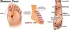 Best Diabetic Foot Treatment in Rohini, Pitampura, Delhi - Tandon Clinic