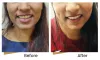 Visit Dr. Ashish Ghuge Clinic for Dimple creation Mumbai