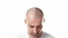Does the Crown take longer to grow after a Hair Transplant? - American Article