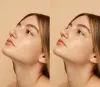 Double Chin Treatment in Delhi