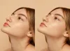 Double Chin Treatment in Delhi