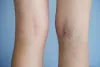Sclerotherapy Boston, MA