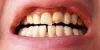 Restorative Dentistry Near Me in Houston