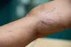 6 Warning Signs for Vein Disease