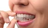      Invisalign in Brooklyn to Straighten Your Teeth