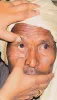 Dry Eyes Treatment Under Mission4Vision Program - Charitable NGO UK