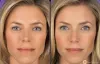 Benefits of Dermal Fillers or Lip Injections Toronto