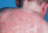 Best Skin Allergy/Eczema Treatment Specialist/Expert in Delhi, South Delhi, Greater Kailash | Dr. Kandhari’s Skin &amp; Dental Clinic