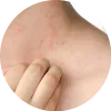 Leading Dermatologist in Bandra &amp; Andheri | Resolve The Skin Related Issues in Affordable Price By The Skin Specialist in Mumbai