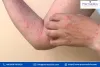 eczema dark skin