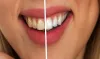 Natural Teeth Whitening Tips for Stained or Yellow Teeth
