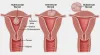 Fibroid Surgery Cost in delhi