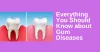 Everything You Should Know about Gum Diseases (Periodontitis) 