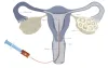 Frozen Embryo Transfer: Know its Cost, Process &amp; Clinic in Delhi, India