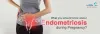 What You Should Know About Endometriosis During Pregnancy
