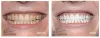 Add sparkle to your smile with teeth whitening in London 