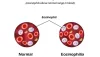 How to Reduce Eosinophil Count In Ayurveda?