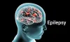 Epilepsy Treatment