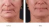 Say Goodbye to Wrinkles: Exilis Treatment in Dubai Revealed!