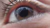 What is Glaucoma? Cause, Symptoms and Treatment
