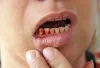 Emergency Dentist — Tooth Extraction: What Are The Different Types?
