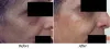 Treatment for instant glow in Delhi - Non Surgical Facelift