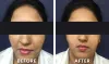 Face Rejuvenation Treatment in New Delhi | The Aesculpir