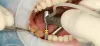 Facts to Consider About Dental Implant Procedures