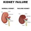 Kidney Failure Treatment in Ayurveda - Kidney And Ayurveda