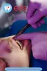 Full Dentures Implants in Alabama