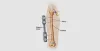 Femur Shaft Fractures: Types, Cause &amp; Symptoms