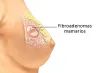 Fibroadenoma treatment in Pune - Deccan Clinic