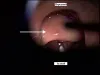 ЛОР-проявления воспалительных заболеваний кишечника - Проект Побеждая НЯК