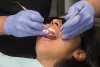 Periodontitis Causes, Symptoms | Periodontal Disease Treatment Near Me