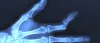 How challenging is bone dislocation to an orthopedic surgeon? omg blog