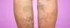 Frequently Asked Questions (FAQs) about Vein Disorder – Manhattan Vein Center