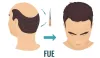 FUE Hair Transplant and Its Multiple Benefits