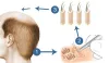 FUE Hair Transplant in Peshawar Pakistan 