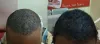 FUE Hair Transplant in Tirupati | Best Hair clinic in Tirupati