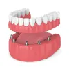 Cheapest Dental Implants in Dubai &amp; Abu Dhabi | Implantologist Cost