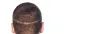 Best FUT Hair Transplant Treatment In Delhi NCR
