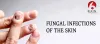 Fungal Skin Infections
