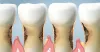 Gum Treatment in Coimbatore | Gum Care in Race Course