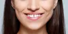 How To Fix Gap In Front Teeth Without Braces?