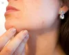 Gardner’s Syndrome