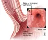 Heartburn Treatment | Gastroesophageal reflux disease (GERD) Specialist in Ahmedabad Gujarat India