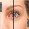 glaucoma-before-after.jpg