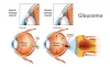 What Is Usually the First Sign of Glaucoma?