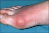 How to Lower High Uric Acid Levels Naturally?
